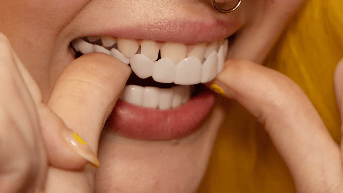 Instant smile transformation with Snap on Smile Veneers 6